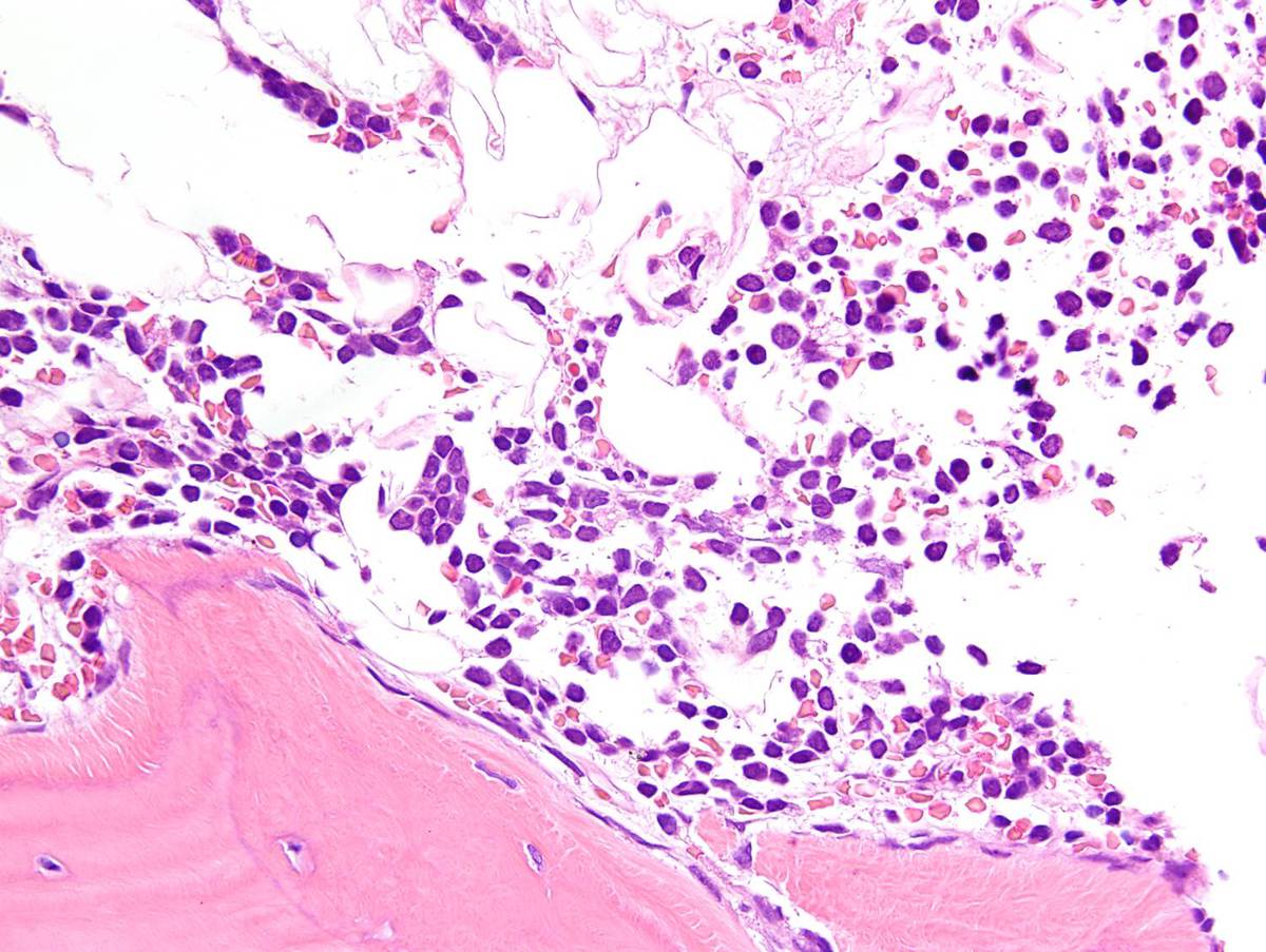 Bone marrow biopsy at the time of leukemic presentation